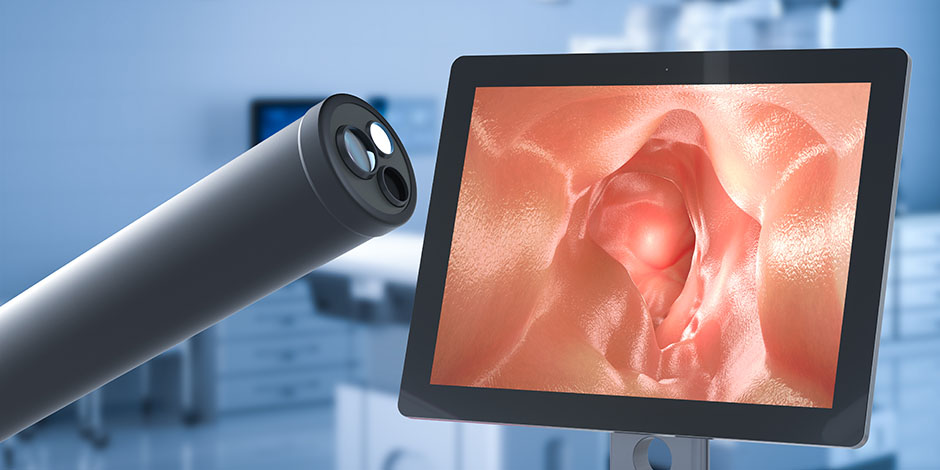 colonoscopy_ss_1523187410